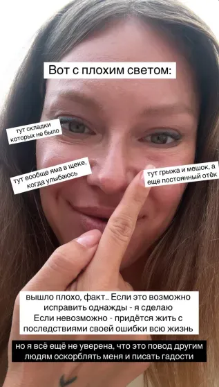 "Хотела стать красивее и моложе. Не вышло". Рита Дакота рассказала о неудачной пластике глаз "Хотела стать красивее и моложе. Не вышло". Рита Дакота рассказала о неудачной пластике глаз