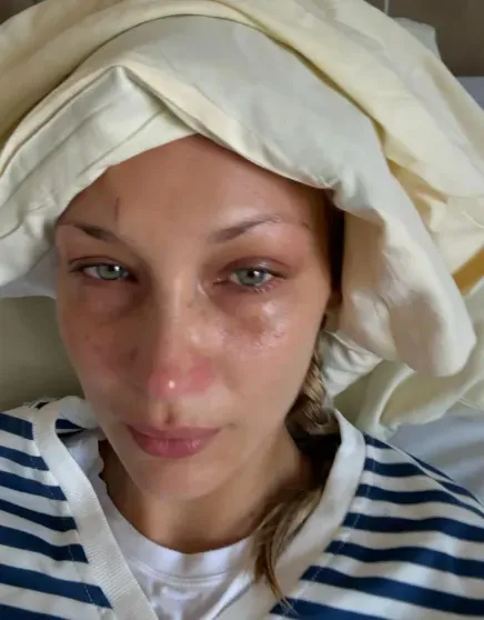 В сети подозревают, что Белла Хадид страдает не от болезни Лайма, а от последствий анорексии