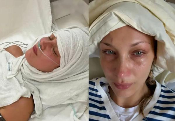 В сети подозревают, что Белла Хадид страдает не от болезни Лайма, а от последствий анорексии